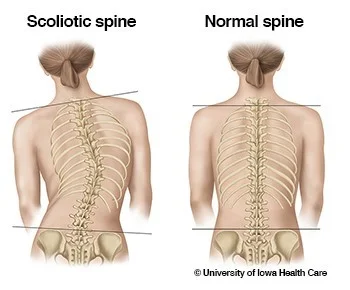 scoliotic vs normal spine